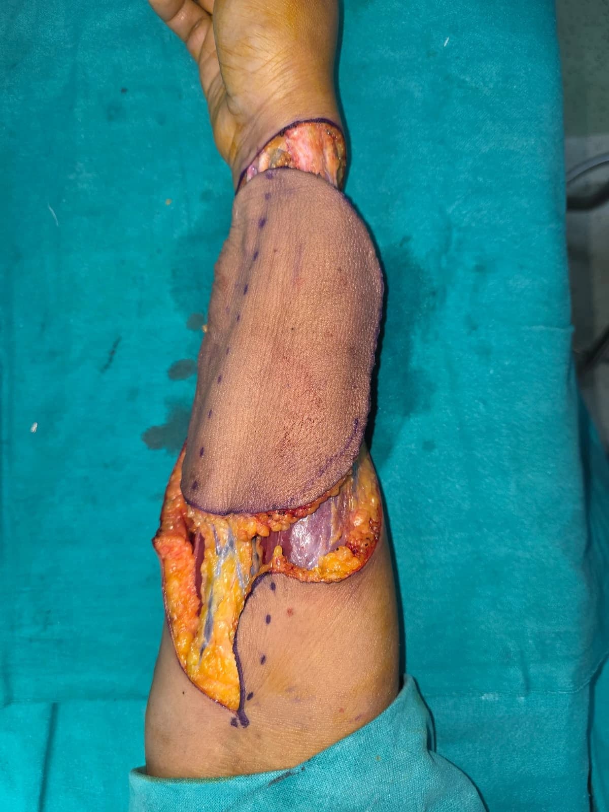 Soft Tissue Sarcoma (Elbow)