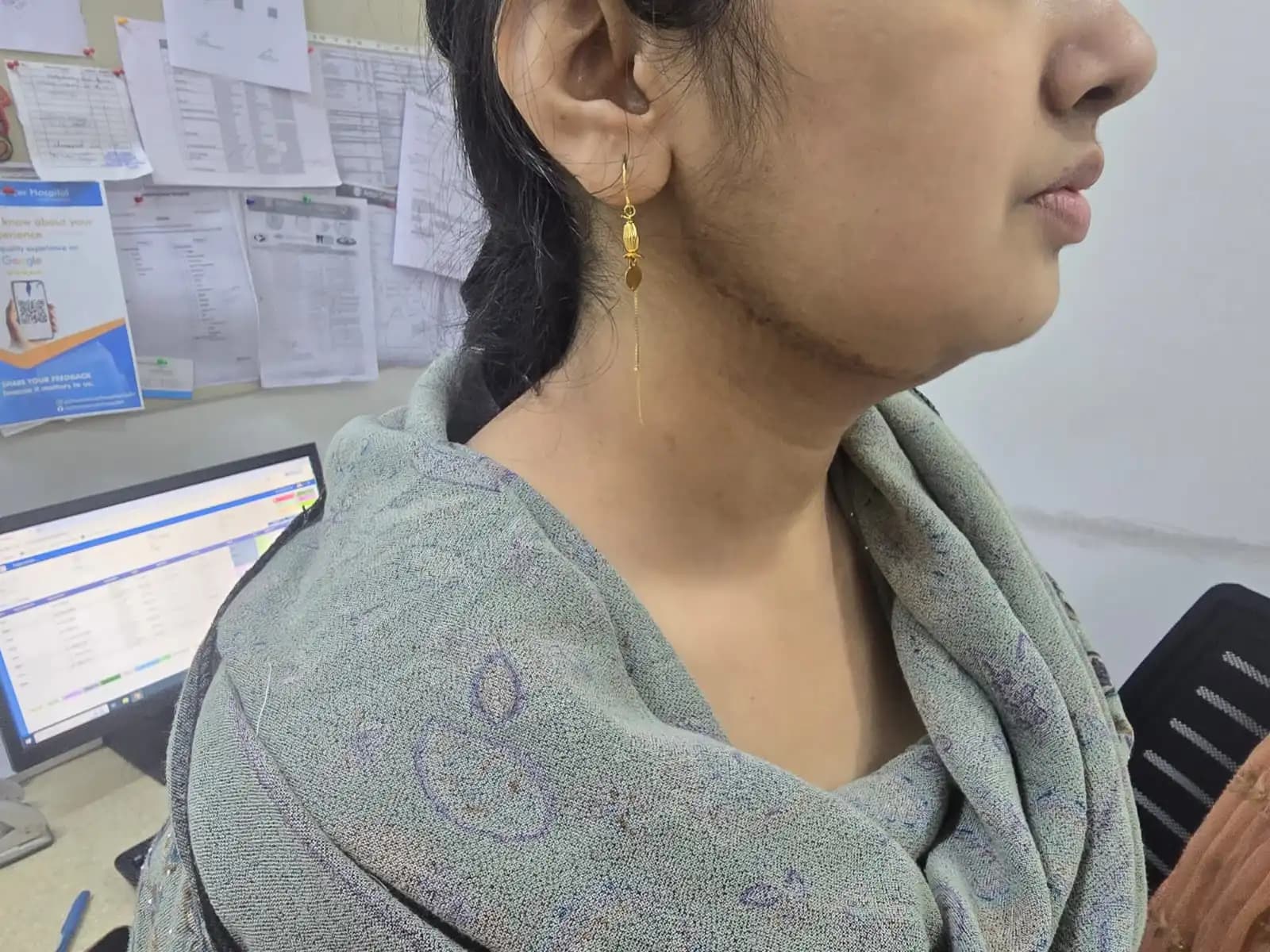 Recurrent Ameloblastoma