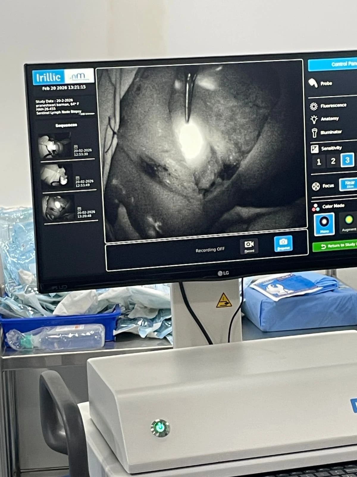 ICG & Methylene Blue Guided Sentinel Node Biopsy